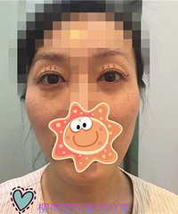 全脸提升效果怎么样