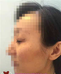 全脸提升效果怎么样