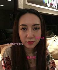 人参娃娃手术恢复时间%¥人参娃娃手术最好的医院