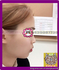 玻尿酸隆鼻能维持多久