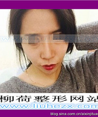 在柳荷这里做了硅胶假体隆鼻给你们看看对比牙