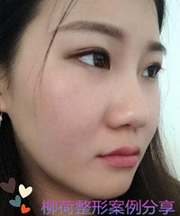 韩式小翘鼻北京哪家医院可以做啊
