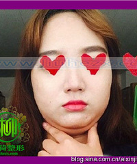 脸大吸脂有用吗%¥吸脂手术可以维持多久啊?