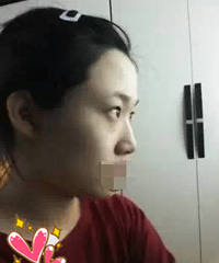 全脸脂肪填充术前术后对比照片