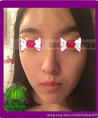 全脸脂肪填充手术恢复时间¥#脂肪填充手术价格