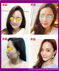 注射瘦脸针前后对比照片¥#玻尿酸下巴维持时间