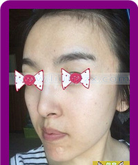 全脸脂肪填充手术恢复时间¥#脂肪填充手术价格