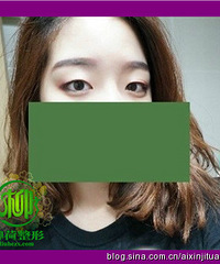 全切双眼皮多久能化妆
