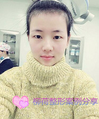 切开双眼皮手术价格¥#北京做切开双眼皮手术价格