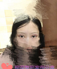 全切双眼皮恢复时间