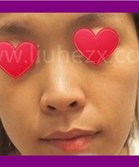 鼻综合手术是终生嘛