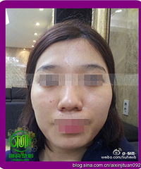 面部吸脂手术安全吗
