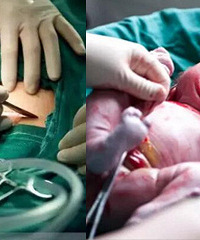据说剖腹产要花开肚子7层取出宝宝