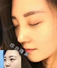 做了鼻子更有自信了