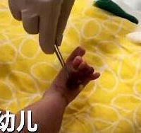 宝宝脚趾被头发丝缠住险被截肢