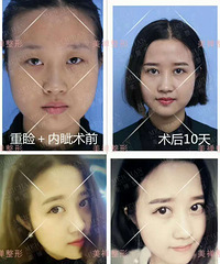 割双眼皮+开眼角案例