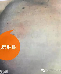 堵奶时揉了,硬块怎么还不散?