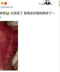 阿娇晒刮痧照,医生都看不下去了