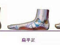 有没有扁平足的妹子?你平时都穿什么鞋?给你们安利一个单鞋神器