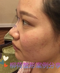 鼻综合手术恢复时间 &% 鼻综合手术价格