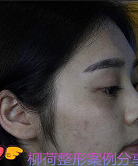 注射水光恢复时间 &% 注射水光针对比照片