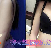 假体隆胸价格 *% 隆胸手术哪种假体最好