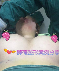 曼托假体隆胸价格 &@ 假体隆胸对比照片