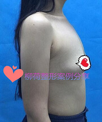 自体脂肪填充手术价格 *¥ 自体脂肪填充手术恢复时间