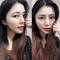 隆鼻后15天 边蜕变边分享