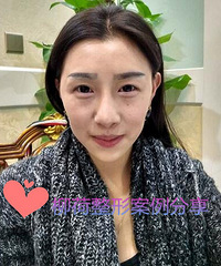 脂肪填充手术恢复时间 %¥ 脂肪填充手术对比照片