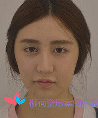 面部吸脂手术价格 *¥ 吸脂手术最好的医院