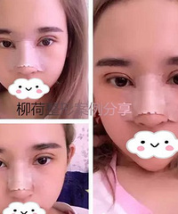 假体隆鼻手术价格 %@ 假体隆鼻恢复时间