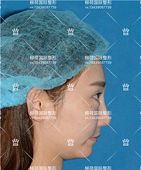 硅胶垫下巴多少钱 &* 眼睑下至手术对比图