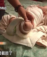 护士忘了关吹风机,婴儿被截肢!