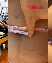 �����鱻ҽ��˵����û�պã�����һ�ڲ���ѵ���ζ�������3cm