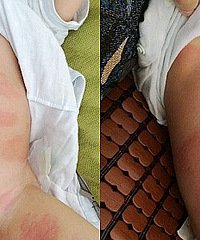 ҿ޶ϳĵʲôòʲôҩ