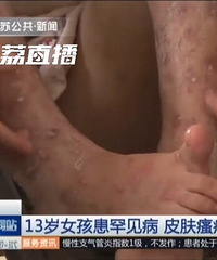 13岁女孩患罕见病最怕热,家贫买不起空调靠奶奶背起来回走