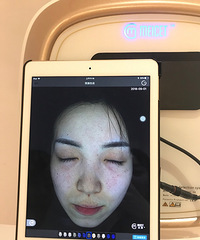 皮肤肤色不匀、还有细纹,现在这些不仅得到了改善连毛孔也缩小了