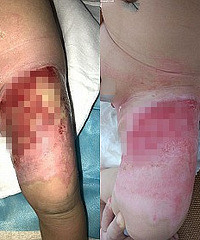 ޶أ4ҽԺֲƤһԵ̬ƫ