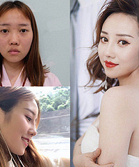 隆鼻之后才发现,原来自己可以这么美