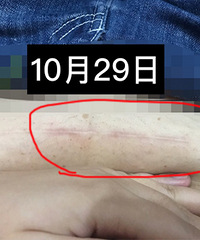 用了它剖腹产伤口变淡了