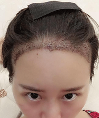惨不忍睹的发际线,分享下我的植发经历和效果。。。
