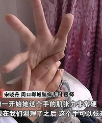 女童误喝妈妈泡的山豆根茶 致手脚变形严重脑损伤