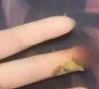 女孩手指受伤,奶奶涂花椒致截肢