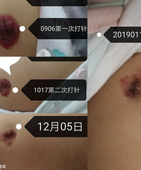 请教一下血管瘤打针后多久才消退或者会变成什么样子啊