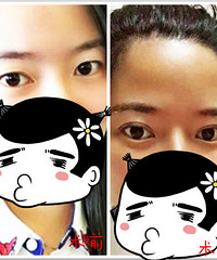 成都做完双眼皮,术后如何护理呢?