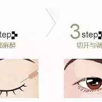 成都割双眼皮哪里好?双眼皮手术之答疑篇