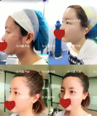 成都自体脂肪填充,刘晶:自体脂肪填充效果怎么样?