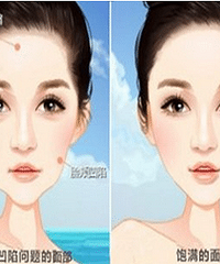 成都刘晶:什么是自体脂肪脸部填充?整形效果如何呢?