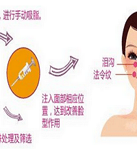 成都刘晶:什么是自体脂肪脸部填充?整形效果如何呢?